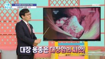 [HEALTHY] Colorectal polyps are the seeds of colon cancer!,기분 좋은 날 20220902