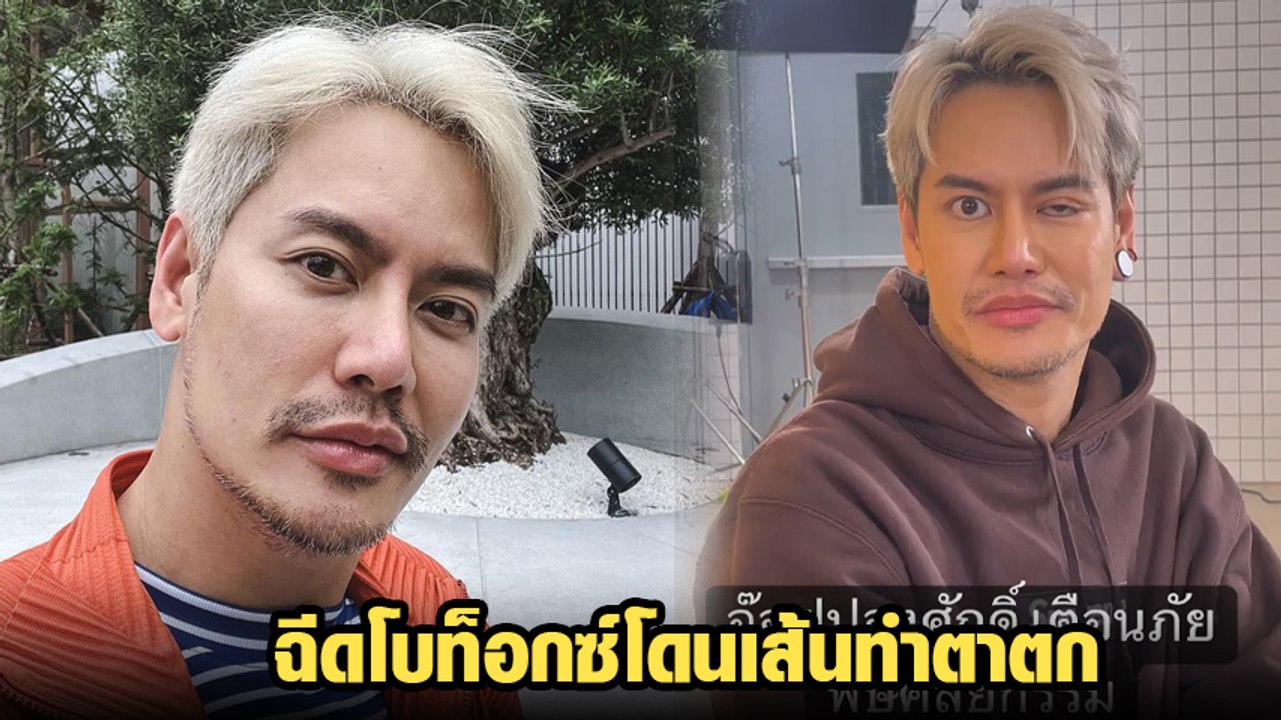 อ๊อฟ ปองศักดิ์ เตือนภัย ฉีดโบท็อกซ์โดนเส้นทำตาต...