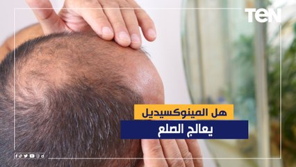 Download Video: يسبب الهبوط.. الدكتور هاني الناظر يحذر من المينوكسيديل لعلاج الصلع