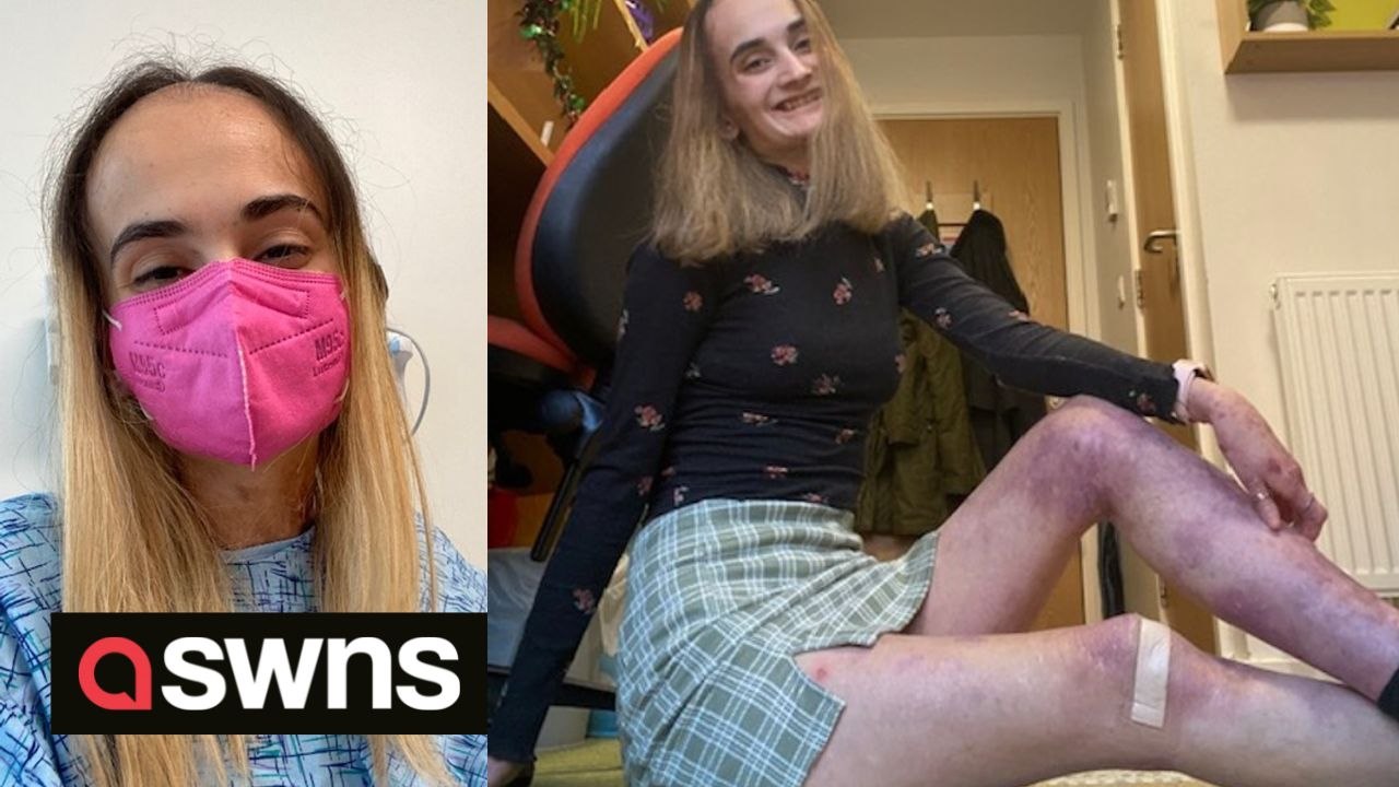 US woman with rare skin condition says her skin is so fragile it's like 'butterfly wings'