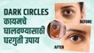 डोळ्याखालचे काळे वर्तुळं घालवण्यासाठी उपाय | Dark Circles Under Eyes Home Remedy | Lokmat Sakhi