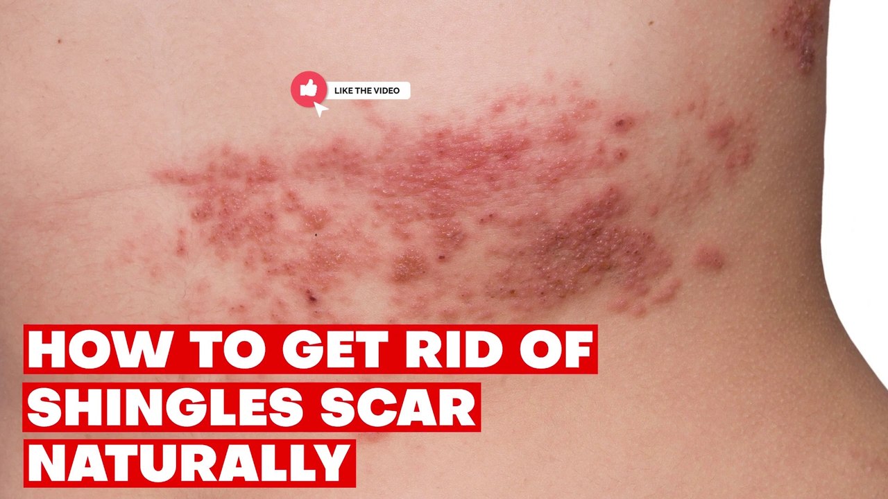 Shingles Scars Removal Naturally: Home remedies you should try