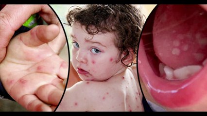 ভারতে এই রোগ ছড়িয়ে পরছে সাবধান