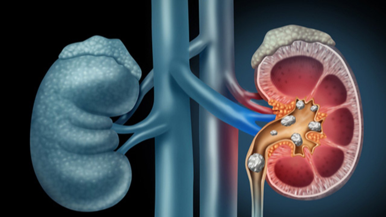 पथरी में कौन सी दाल खानी चाहिए और कौन सी नहीं ? | Stones में कौन सी दाल खाएं | Boldsky*health