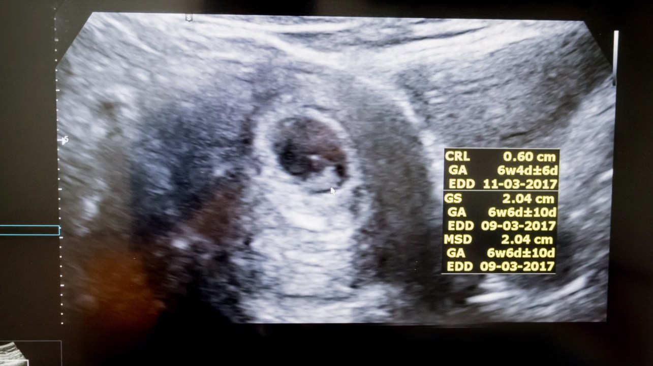 Ungarn zwingt abtreibungswillige, herztöne zu hören