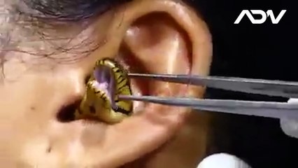 Extraen serpiente viva de la oreja de una mujer en la India