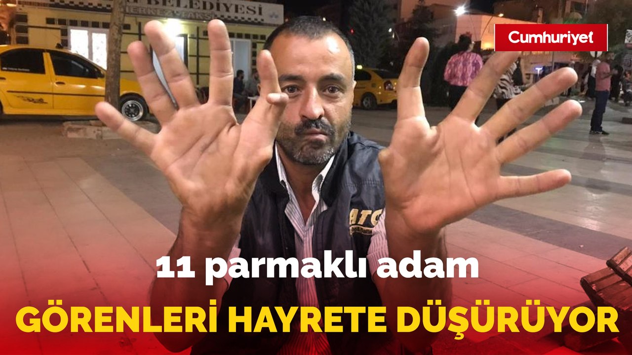 Elazığ’da 11 parmaklı adam görenleri hayrete düşürüyor