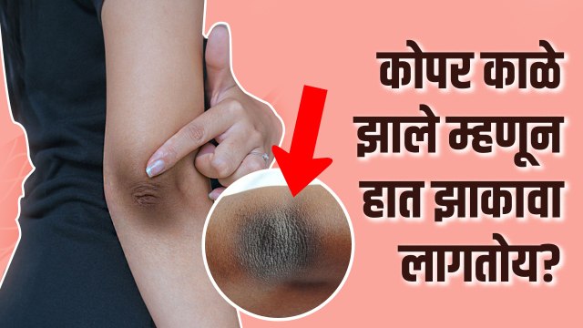 या घरगुती उपायांनी दूर करा कोपराचा काळेपणा | How to Lighten Dark Elbows | Black Elbow Removal
