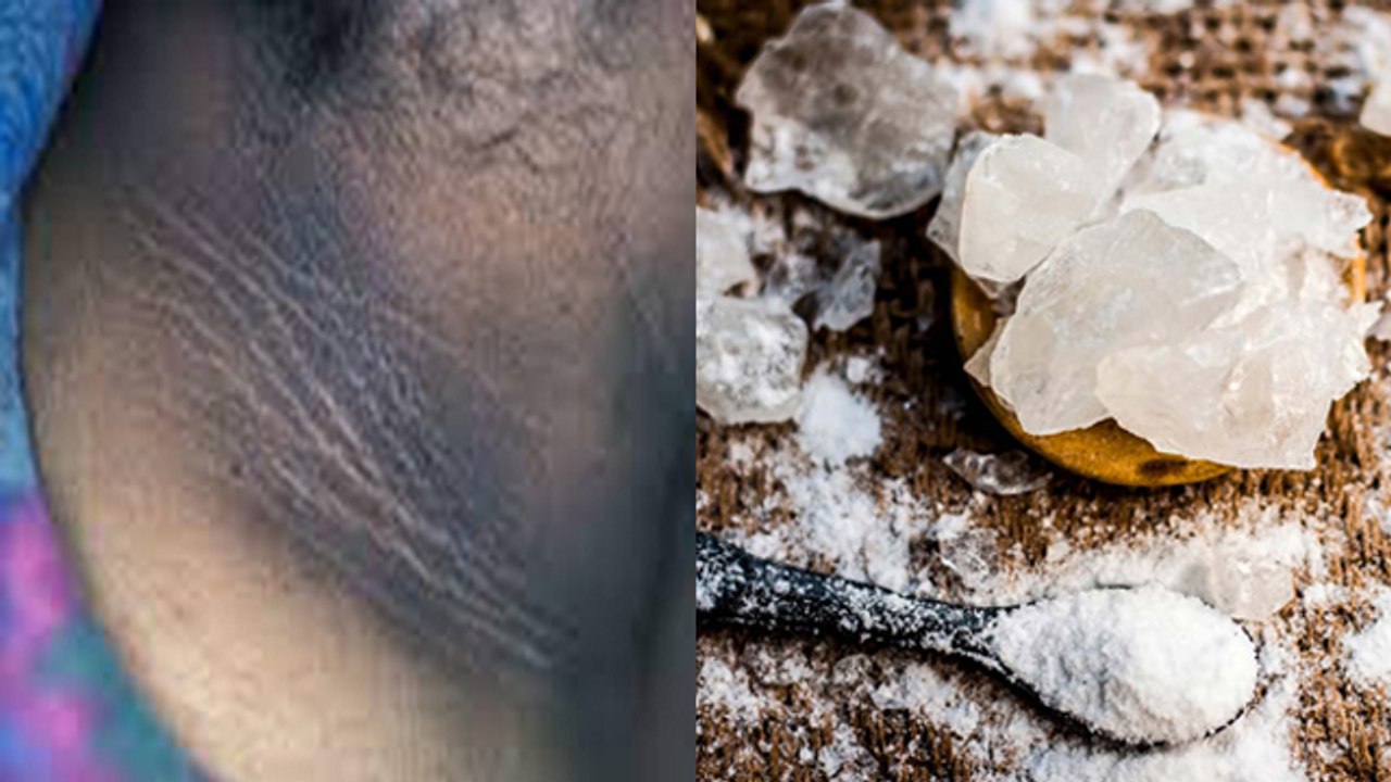 गर्दन का कालापन हमेशा के लिए दूर करेगा फिटकरी बस जान ले इस्तेमाल करने का तरीका। Boldsky *Health