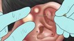 AAMR Pimple blackhead and sebaceous cyst removal for gamer _ Massage ear - Tingle animation(480P)