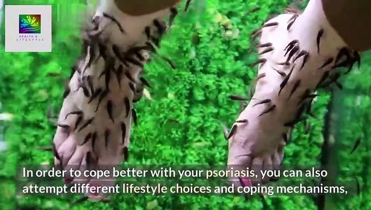 Psoriasis Complete Guide