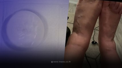 สาวป่วยแปลกๆ นาน 10 ปี รักษากี่หมอไม่หาย กระทั่งลองผ่าซิลิโคนเสริมหน้าอกออก