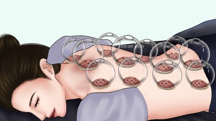 AAMR Cupping therapy and back massage for pain relief _ Hijima treatment animation(2K_HD)