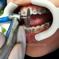 Interproximal Reduction (IPR): A Complete Guide to Tooth Slimming & Orthodontic Benefits 🦷