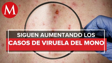 Sube a mil 367 casos de viruela símica en la República Mexicana