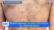Nuevos casos de viruela del mono en México, 4 son de menores de edad