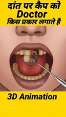 खराब दांत पर कैप 3D Animation  #shorts #short #knowledge  #shortvideo #viralshorts