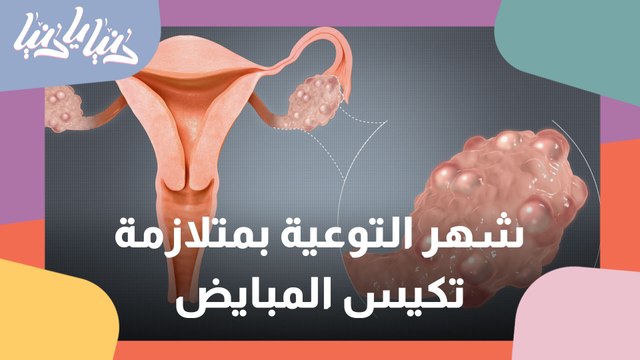 في شهر التوعية بمتلازمة تكيس المبايض ..اليكم هذه النصائح التغذوية للتعامل مع ذلك