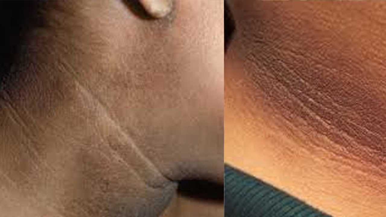 गर्दन पर कालापन क्यों होता है । गर्दन का कालापन ऐसे हटाए । Boldsky *Health