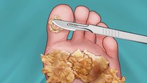 ASMR _ Surgery to Remove Large Plantar Warts Animation _ Corn Foot Calluse HPV Treatment 사마귀 足底疣贅