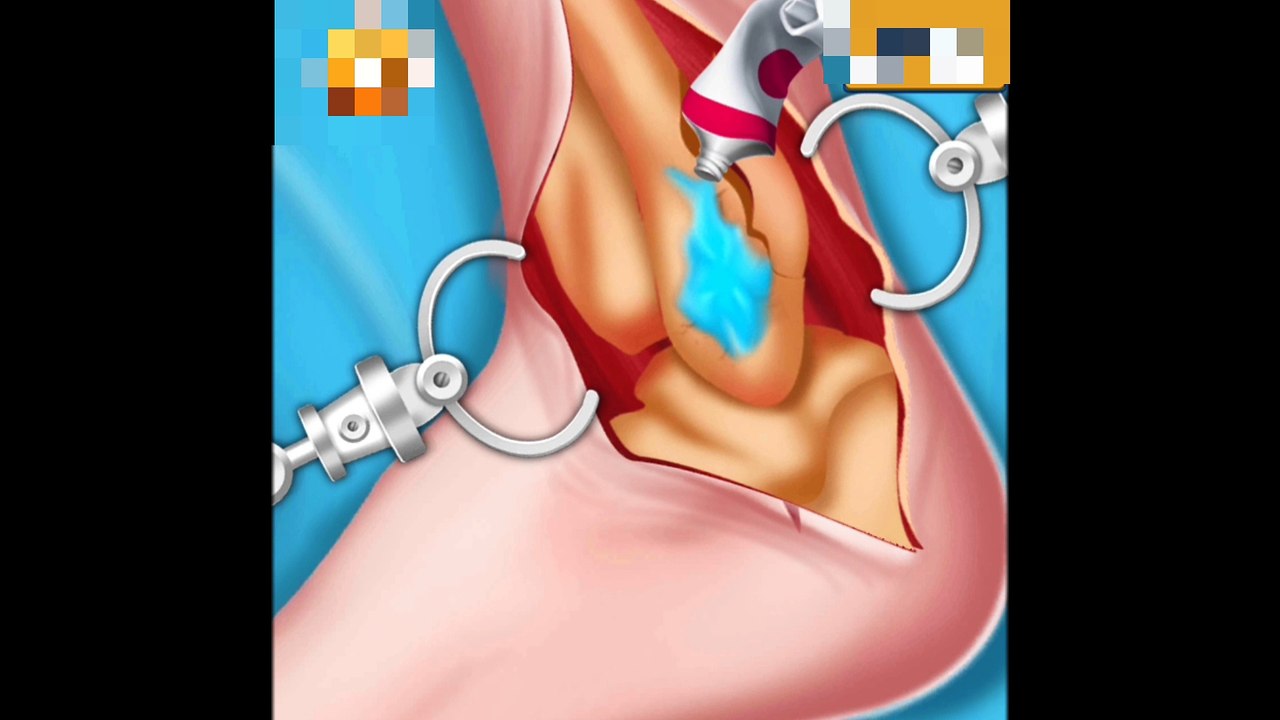 Feet surgery 3d animation
