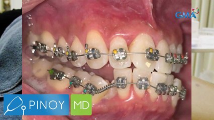 Ngipin na nasira ng DIY braces, maisasalba pa kaya? | Pinoy MD