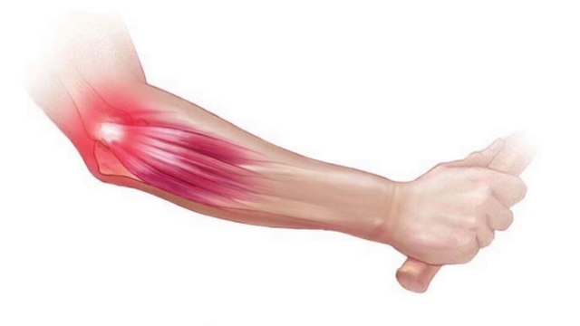 bd-causas-y-tratamientos-para-tendinitis-260922