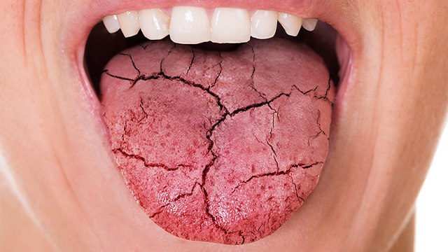 रात को मुंह सूखने का कारण । रात को मुंह क्यों सूखता है जानिए लक्षण और उपाय। Boldsky *Health