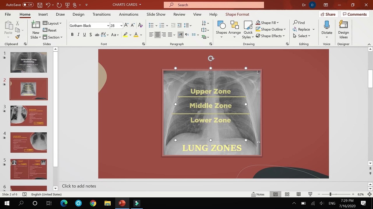 Causes of Interstitial Shadow on Chest Xray Differential Diagnosis