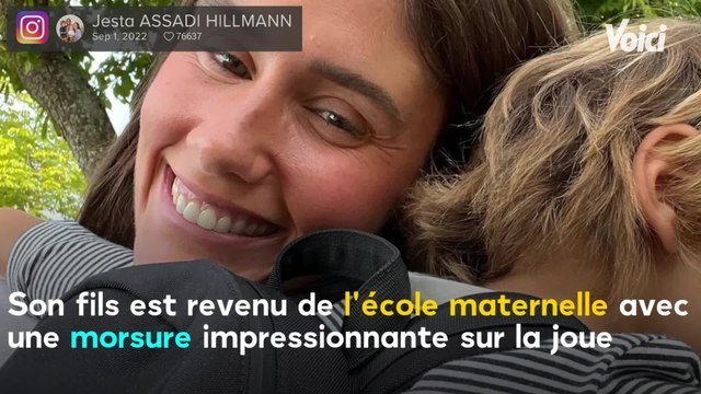 VOICI Il s'est fait manger : Jesta Assadi Hillman partage une photo de son fils Juliann défiguré par une morsure