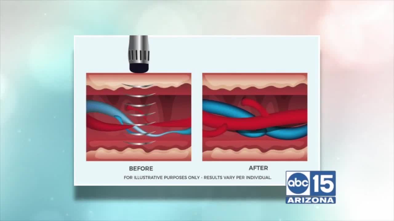 Camelback Medical can treat ED in the office - no pain, no surgery, no pills