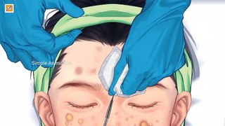 how to remove pimples| simple Animation