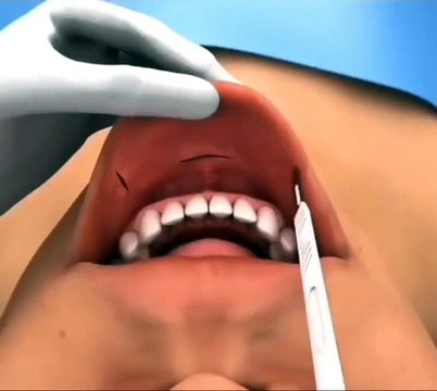 Tiroid bezi ameliyatı nasıl yapılıyor?