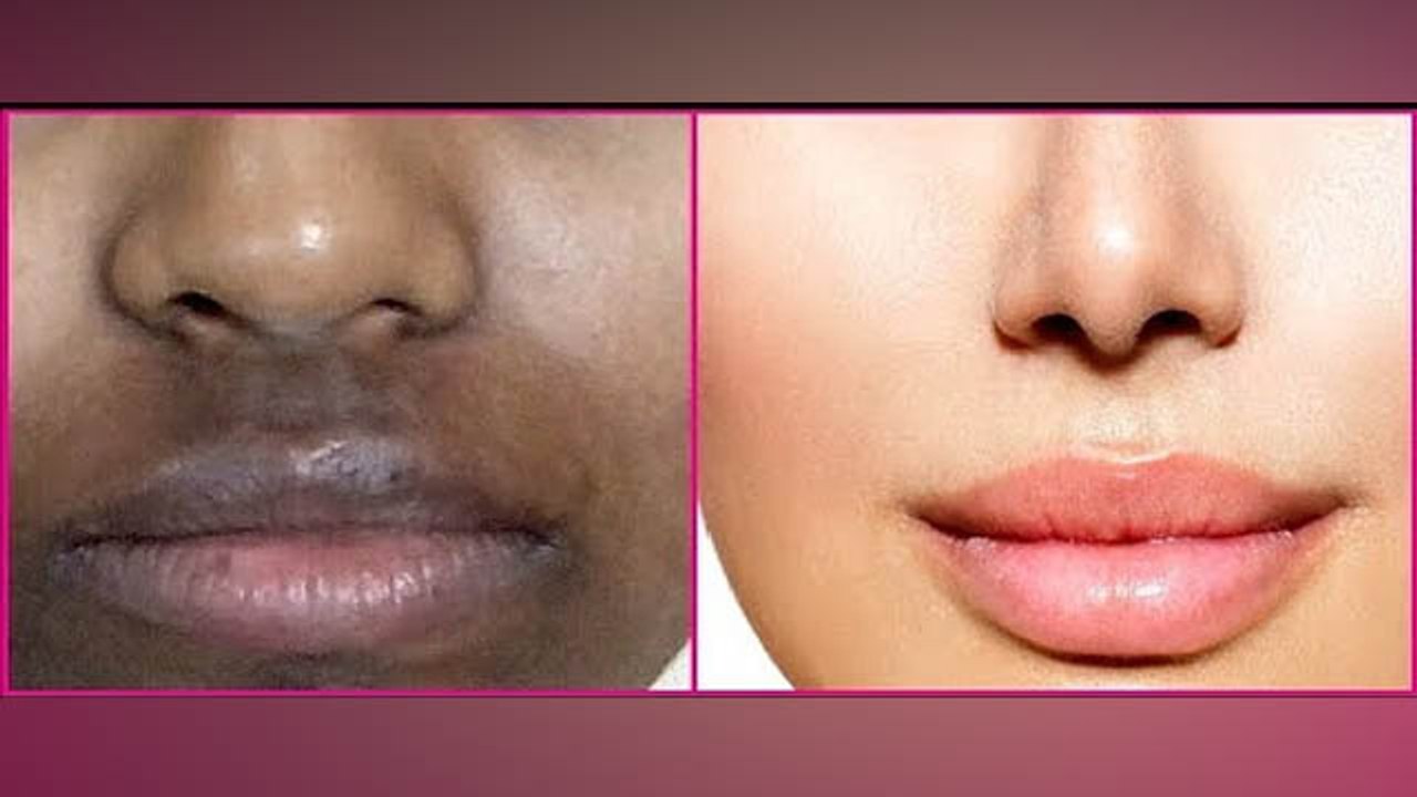 होंठ के ऊपरी हिस्से का कालापन चुटकियों में करें दूर,आजमाएं ये घरेलू उपाय । Boldsky *Health