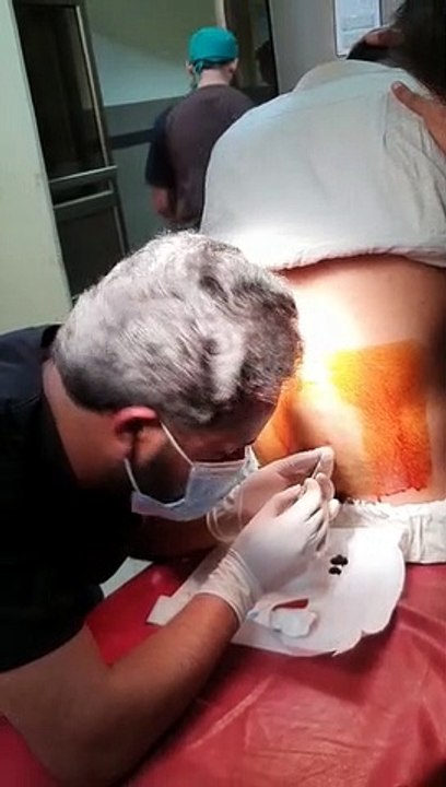 How to give Spinal Anesthesia for labor delivery || Gynecology by MWM Medical