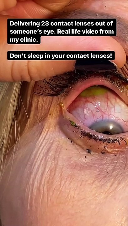 Une ophtalmologue retire 23 lentilles de contact des yeux d'une femme