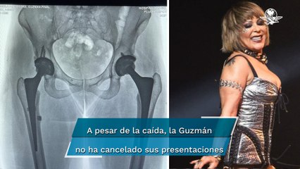 Tras caída, Alejandra Guzmán publica radiografía de su cadera y así se ve
