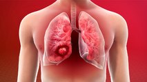 फेफड़ों का कैंसर कैसे होता है ? | कैंसर के लक्षण क्या होते हैं | Lung Cancer Symptoms | *health