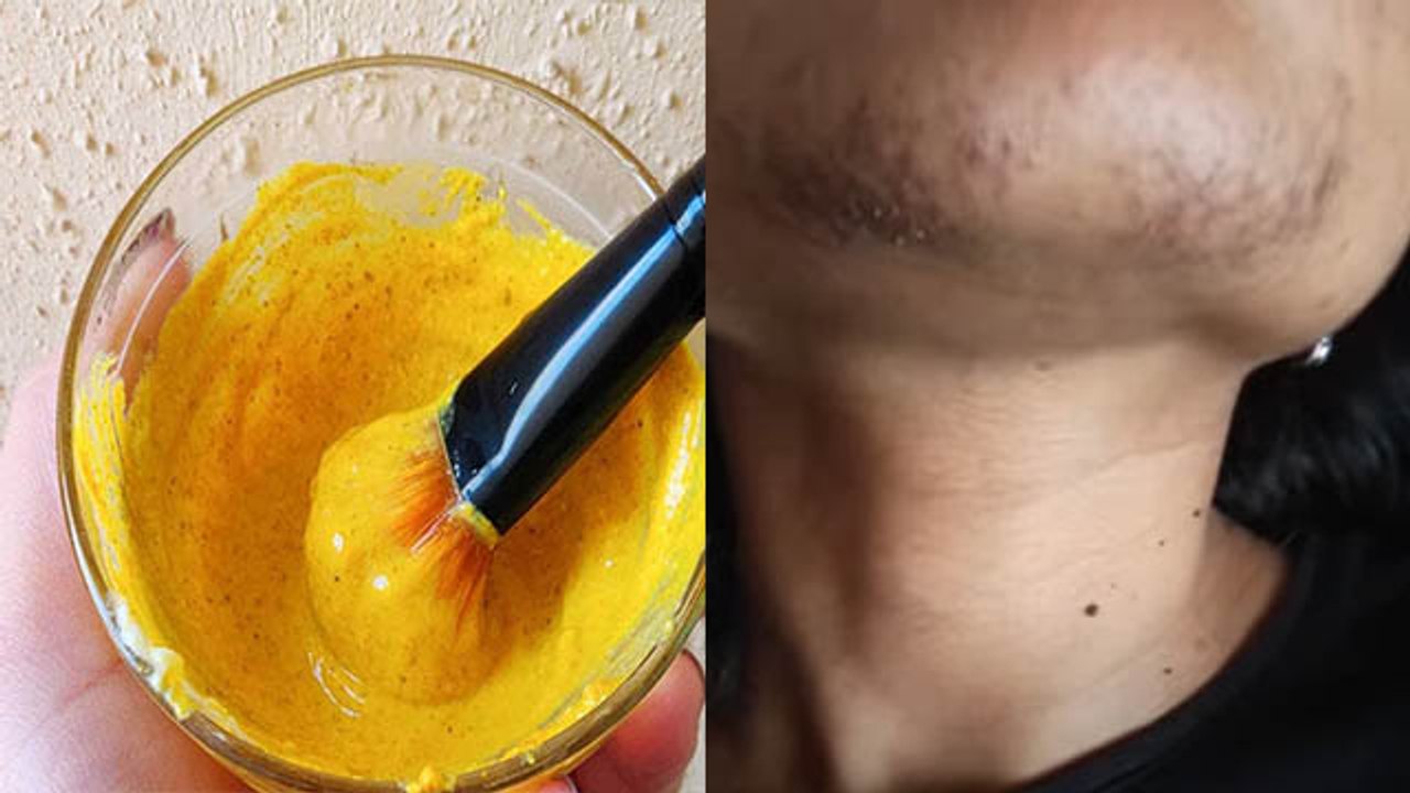 चिन का कालापन दूर करने का सबसे आसान तरीका | Remedies to Remove Chin Blackness | Boldsky *Health