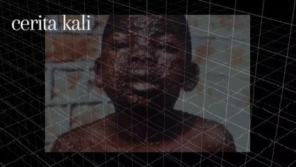 Asal Usul Penyakit Cacar