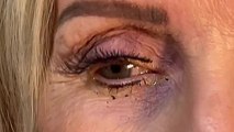 Une ophtalmo retire 23 lentilles de l'œil d'une femme