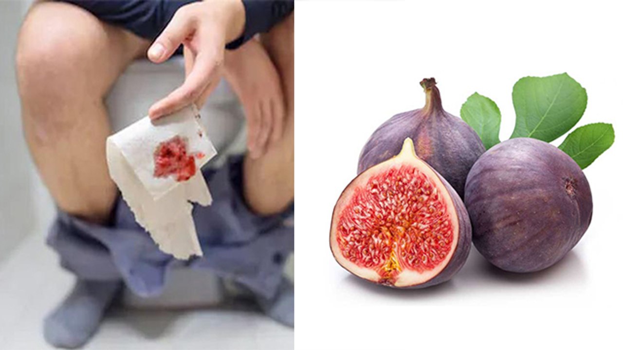 Piles Treatment में अंजीर खाने के फ़ायदे | अंजीर से बवासीर का इलाज | Home Remedies | Boldsky *health