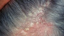 सिर में खुजली होना और बाल झड़ना Scalp Eczema Symptoms तुरंत कराए जांच । Boldsky *Health