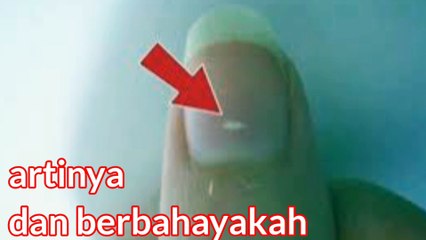 Arti dari Muncul Bintik Putih di Kuku, Apakah Berbahaya? ini penjelasan medis nya