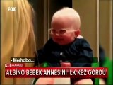 Albino bebek annesini ilk kez gördü