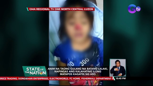Anim na taong gulang na batang lalaki, napingas ang kalahating ilong matapos kagatin ng aso | SONA