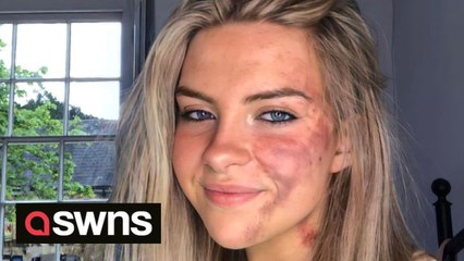 Woman with a skin condition that causes bruise-like rashes all over her face is embracing her natural look