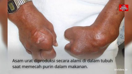 Makanan Penyebab Asam Urat Tinggi