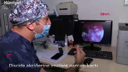 Bursa'da, gittiği dişçide akciğerine implant parçası kaçtı