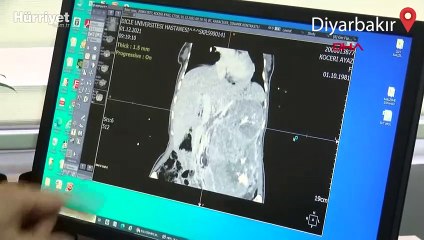 Karnından 5,5 kiloluk böbrek tümörü çıkarıldı